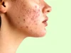 معجزه نوره برای رفع جوش‌های صورت؛ چطور مصرف کنیم؟